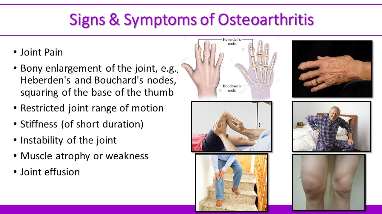 Osteoarthritis