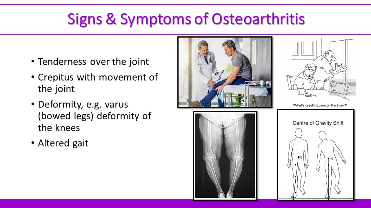 Osteoarthritis   2471aa32f1c5416384c8489d62149342 