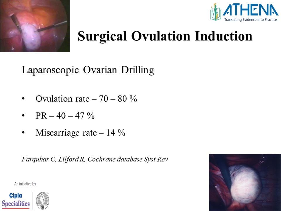 Ovulation Induction & OHSS Free Clinic