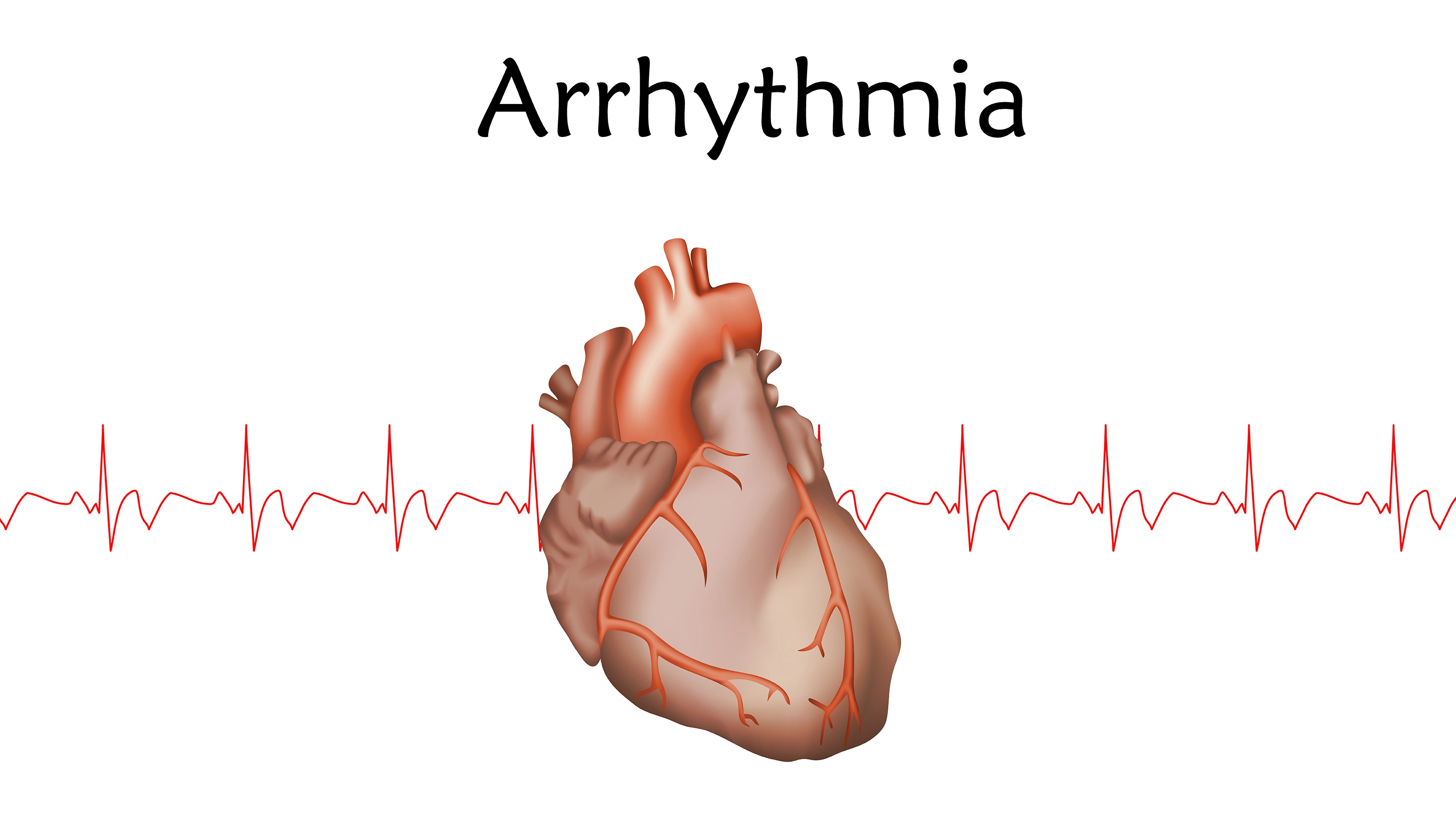 ACC 2023 Athletes With Arrhythmias When to Worry How to Manage