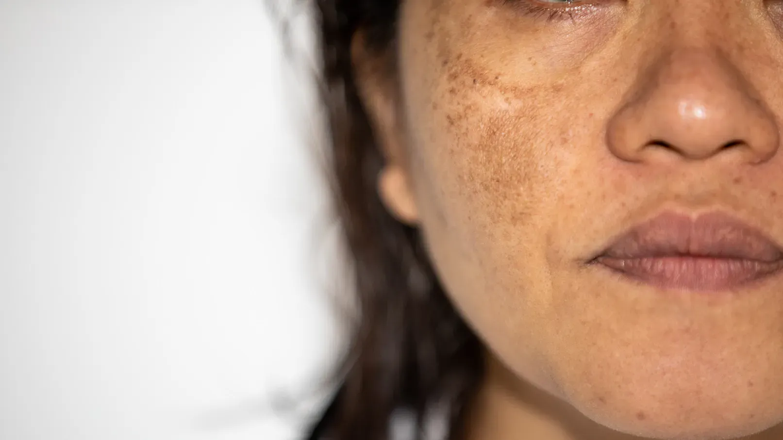 NNHyperpigmentation2_1276345099