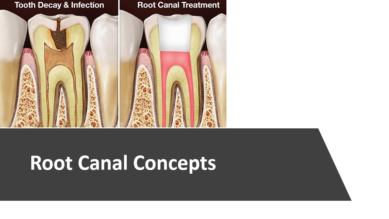 Root Canal Concepts